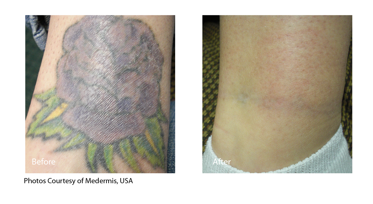 Laser Tattoo Removal Madison - Total Body Laser & Med Spa | Madison  Wisconsin