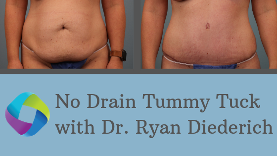 Drainless Tummy Tuck: A Superior Option
